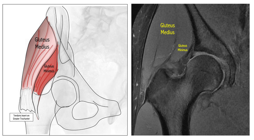 Left, a drawing of the hip showing the gluteus medius and gluteus minimus, with their tendons inserting on the greater trochanter. Right, an MRI of the hip with the same two muscles labeled