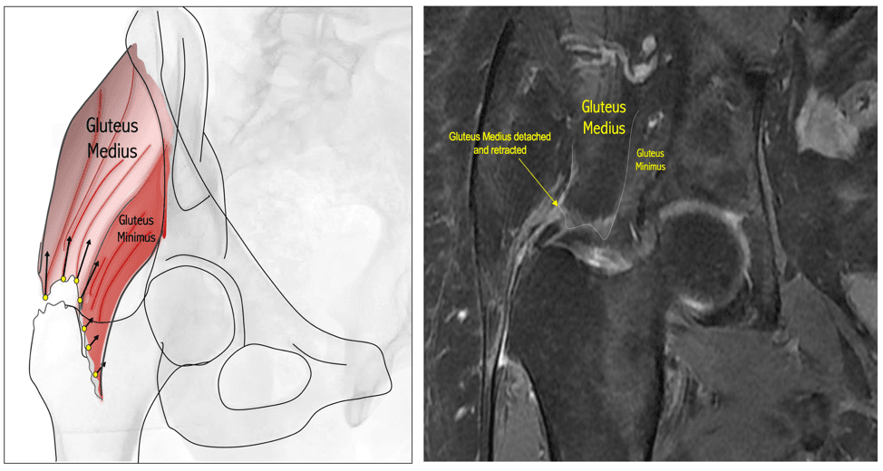 Left, a drawing of the gluteus medius and minimus with yellow points along the greater trochanter and arrows along the tendons. Right, an MRI labeled where the gluteus medius has detached and retracted