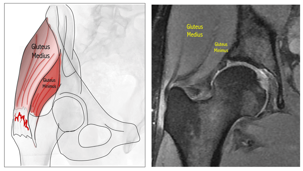 Left, a drawing of the gluteus medius and minimus with red marks of inflammation where the tendons insert on the greater trochanter. Right, an MRI of the hip with the two muscles labeled