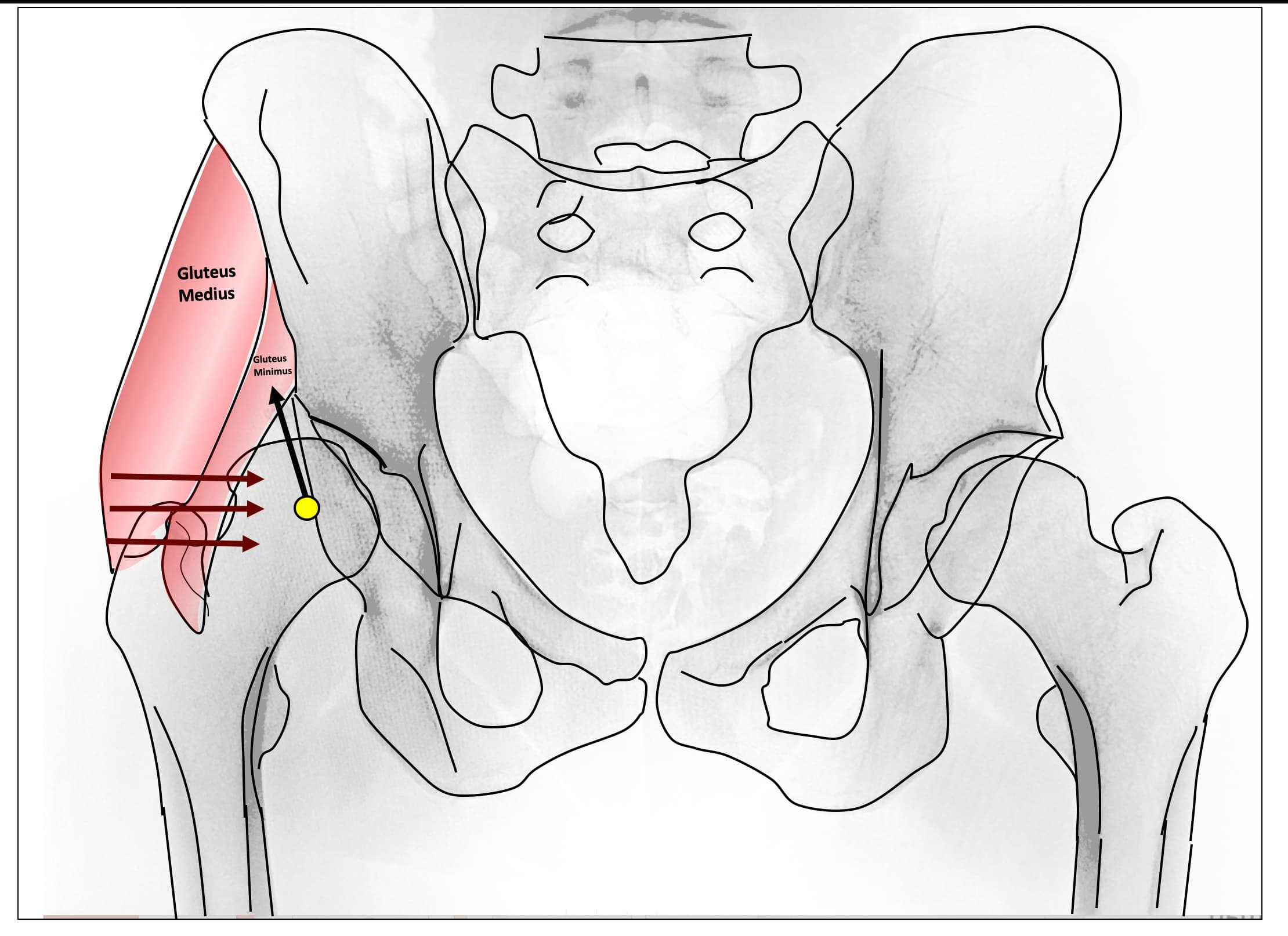 A drawing over an X-ray of the pelvis, showing the gluteus medius and minimus working across a dysplastic hip, with arrows marking the direction of force