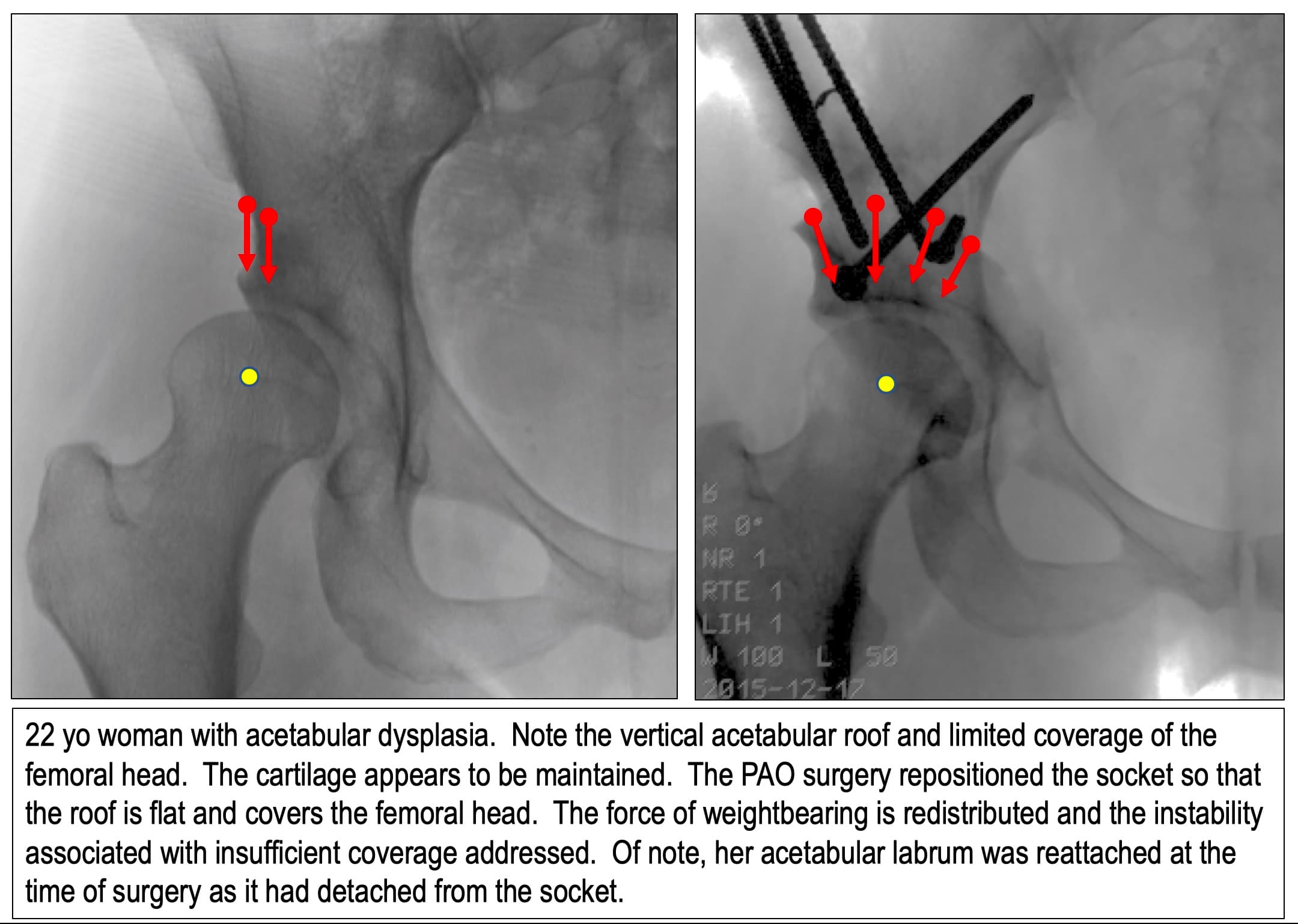 Two X-rays of a 22-year-old woman's dysplastic hip. Left, before surgery, a steep socket roof covers little of the ball. Right, after PAO, screws hold the socket flat over the ball