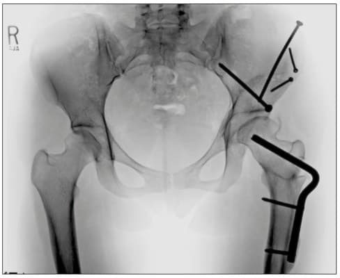 X-ray of a pelvis after surgery, with screws holding the repositioned socket and a plate and screws in the top of the femur