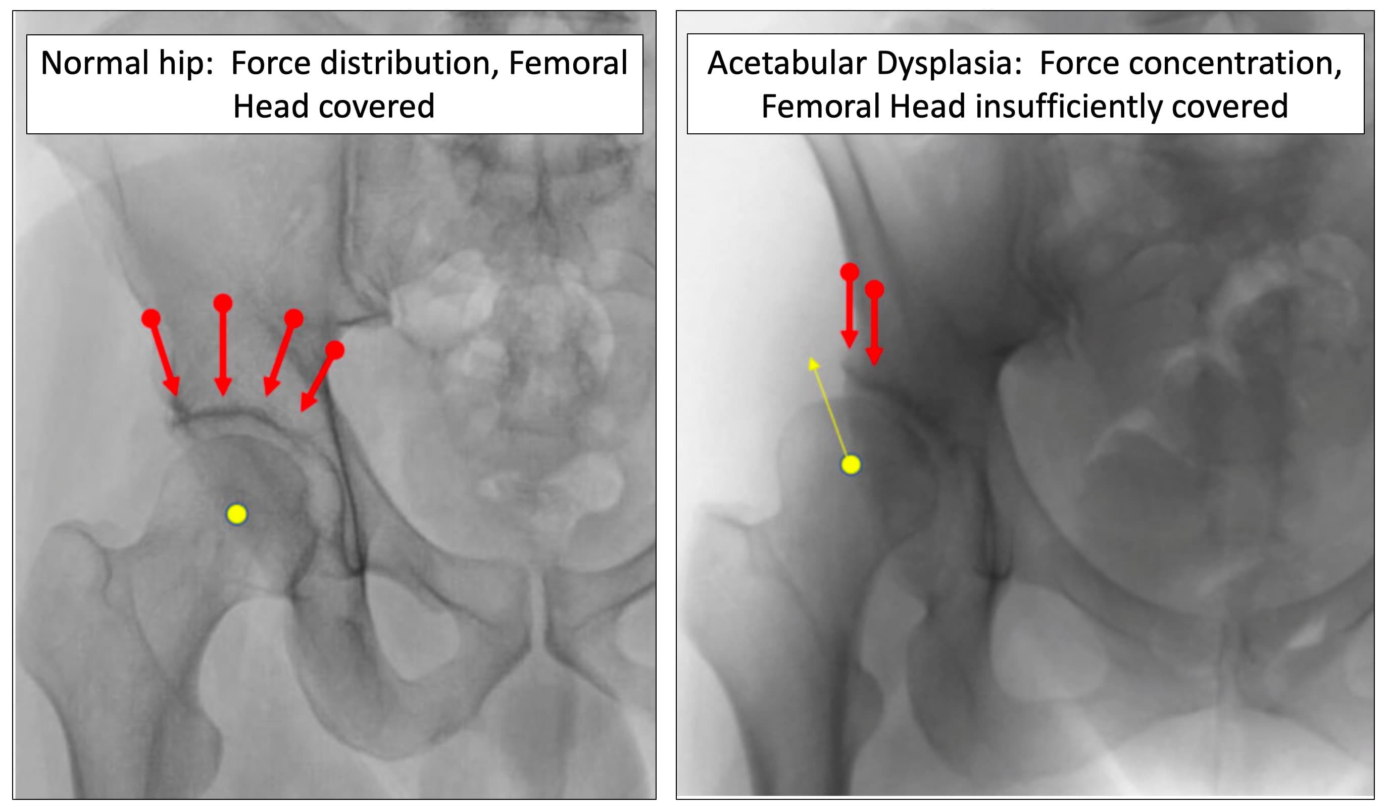 Two X-rays side by side. Left, a normal hip, with arrows showing force spread across a socket that covers the ball. Right, a dysplastic hip, with force concentrated at the rim of a shallow socket that leaves the ball insufficiently covered