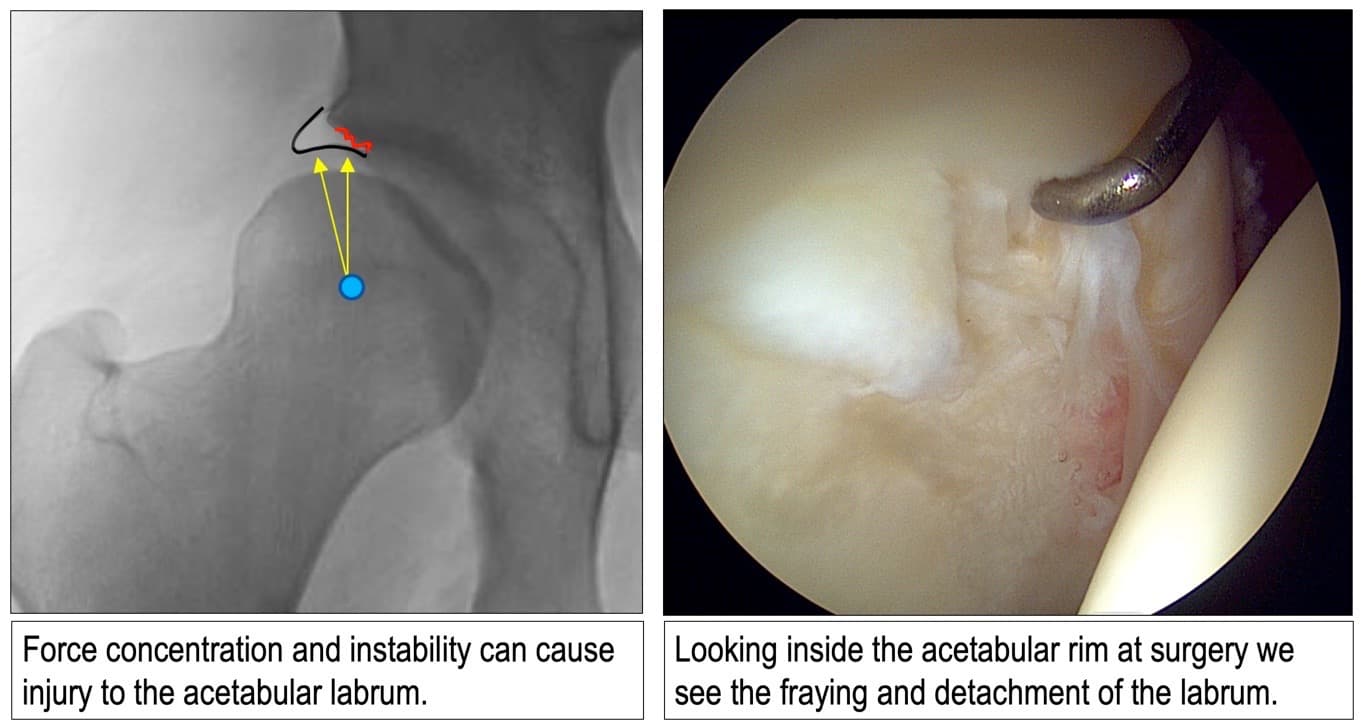 Left, an X-ray of a dysplastic hip with arrows showing force focused on the rim of the socket, where the labrum is injured. Right, an arthroscopic view inside the hip showing a frayed, detached labrum
