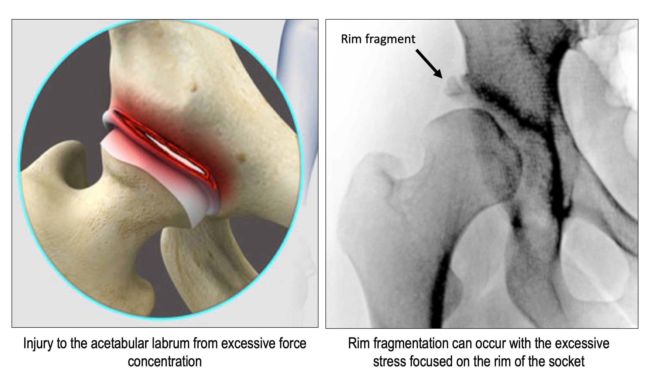Left, an illustration of an injured acetabular labrum. Right, an X-ray with an arrow pointing to a fragment broken off the rim of the socket