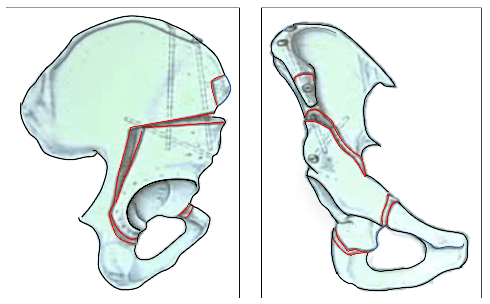 Two drawings of the pelvis, from the side and from the front, with red lines marking the cuts around the socket and the screws that hold it in its new position
