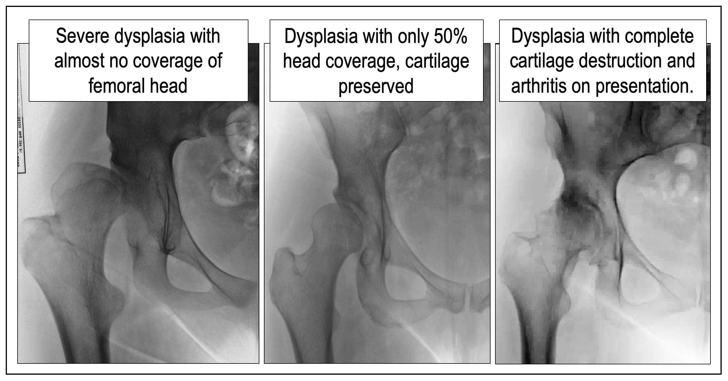 Three X-rays of dysplastic hips: one with almost no coverage of the ball, one with about half coverage and the cartilage preserved, and one with the cartilage destroyed by arthritis