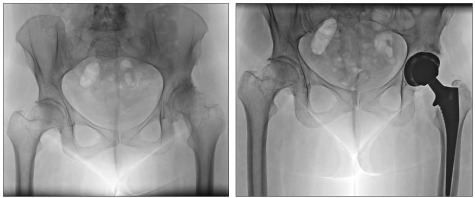Two X-rays of a pelvis. Left, both hips with dysplasia and arthritis. Right, one of the hips replaced with a total hip replacement