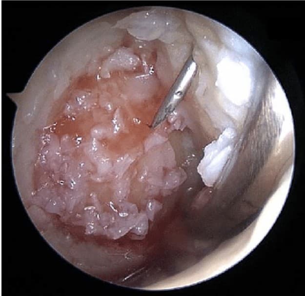 Arthroscopic camera view of minced cartilage fragments packed into a cartilage defect, with a probe beside them