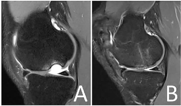 Two side-view MRI scans of a knee, labeled A and B
