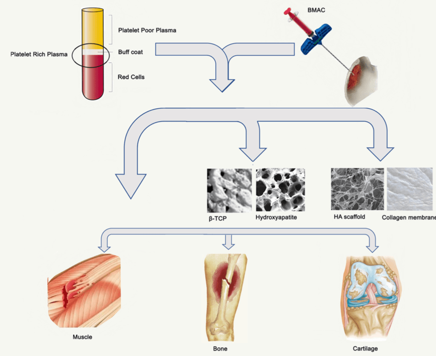 Diagram of platelet rich plasma and bone marrow aspirate concentrate combined with scaffolds to treat muscle, bone and cartilage