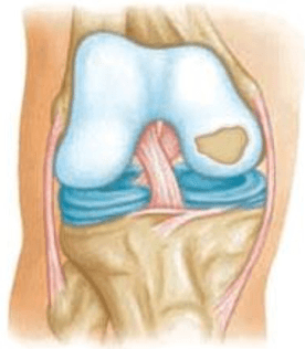 Illustration of the front of a knee with one patch of worn articular cartilage on the end of the thighbone