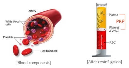 Diagram of blood components in an artery, and a tube after centrifugation with plasma, platelets and red blood cells separated into layers, the platelet-rich layer marked PRP