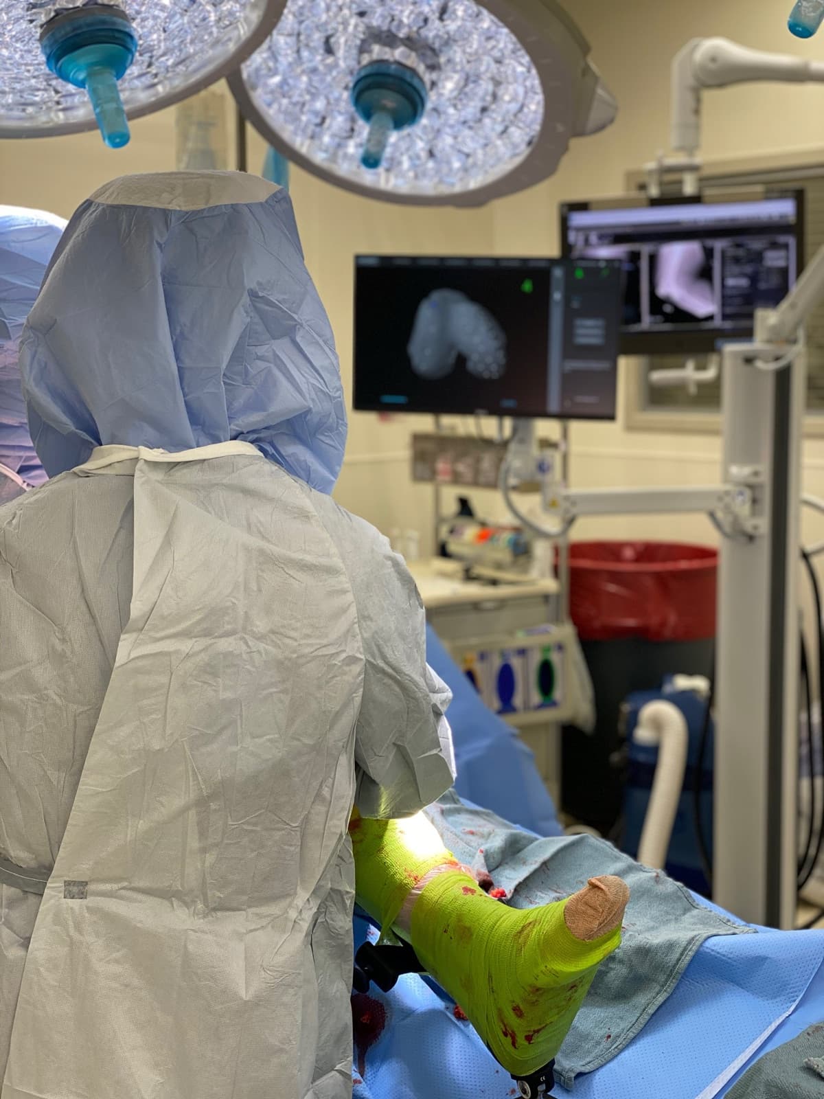 A surgeon in a gown and hood at the operating table, the leg held in a positioner, with a 3D model of the knee bone on the screen beyond