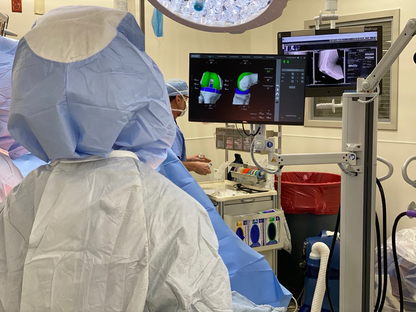 The Mako planning screen in the operating room, showing the knee implants positioned on 3D models of the thighbone and shinbone