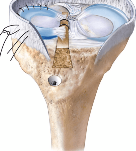 Illustration of a meniscus transplant anchored into the top of the shinbone through a bone tunnel, with stitches along its outer edge