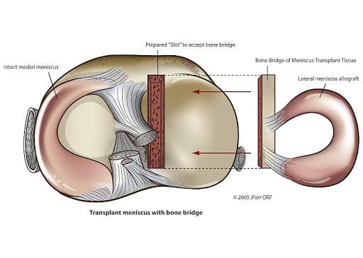 Illustration of the top of the shinbone with a slot prepared beside the intact medial meniscus, and a lateral meniscus allograft on a bone bridge ready to slide into it