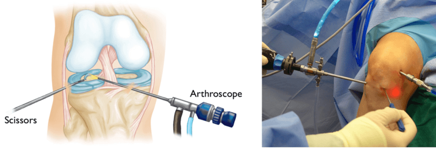Left, an illustration of an arthroscope and scissors inserted into a knee. Right, a photo of the arthroscope and an instrument in a draped knee during surgery