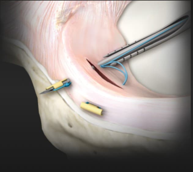 Illustration of a torn meniscus being stitched closed, with a suture device passing through the tear and anchors seated along its outer edge