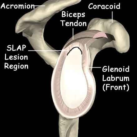Diagram of the shoulder socket seen from the side, labeling the acromion, the coracoid, the biceps tendon, the glenoid labrum around the front of the socket, and the SLAP lesion region at the top where the biceps tendon attaches