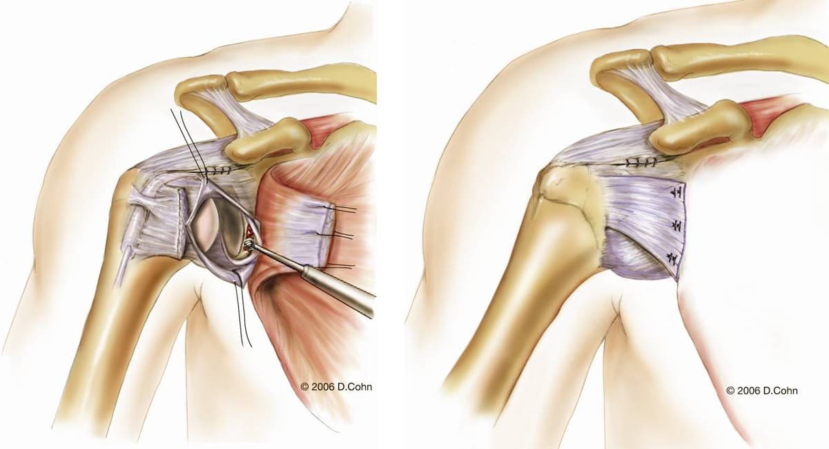 Two illustrations of an open shoulder repair. Left, the front of the joint capsule is opened to show the socket, with sutures in place and a burr at the front rim of the socket. Right, the capsule closed again with rows of stitches